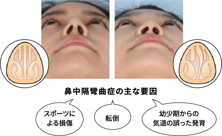 鼻中隔彎曲症の主な要因